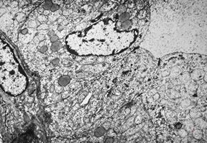 F, 73y. | follicular carcinoma of thyroid gland